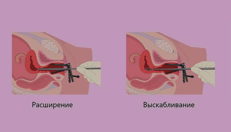 Гистероскопия с РДВ