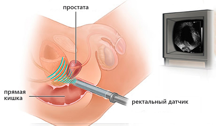 ТРУЗИ простаты