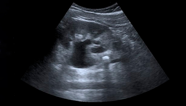 УЗИ почек на дому