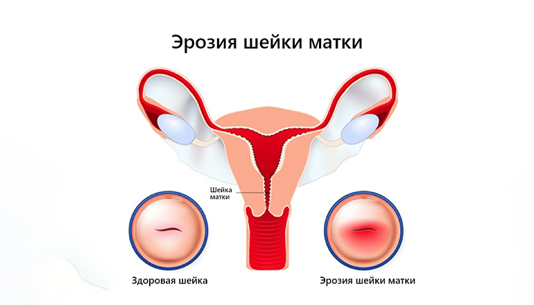 Прижигание эрозии шейки матки
